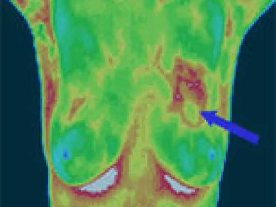 cancer imaging